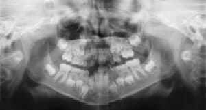 Dental Radiographs (X-Rays) - Pediatric Dentist in Temple Hills, MD, and Richmond, VA