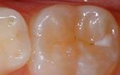 Sealant-Before - Pediatric Dentist in Temple Hills, MD, and Richmond, VA